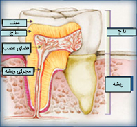 tooth decay